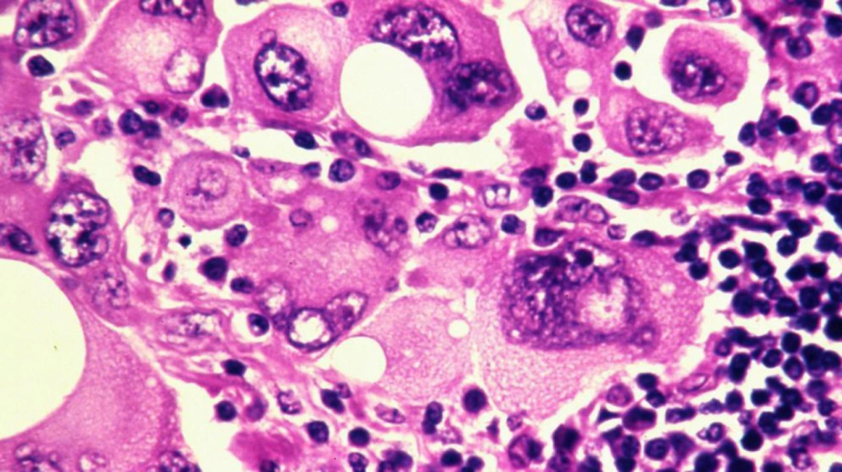Células de cáncer.