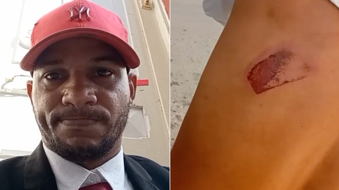 Maykel Osorbo y la herida tras el planazo recibido en La Habana. 