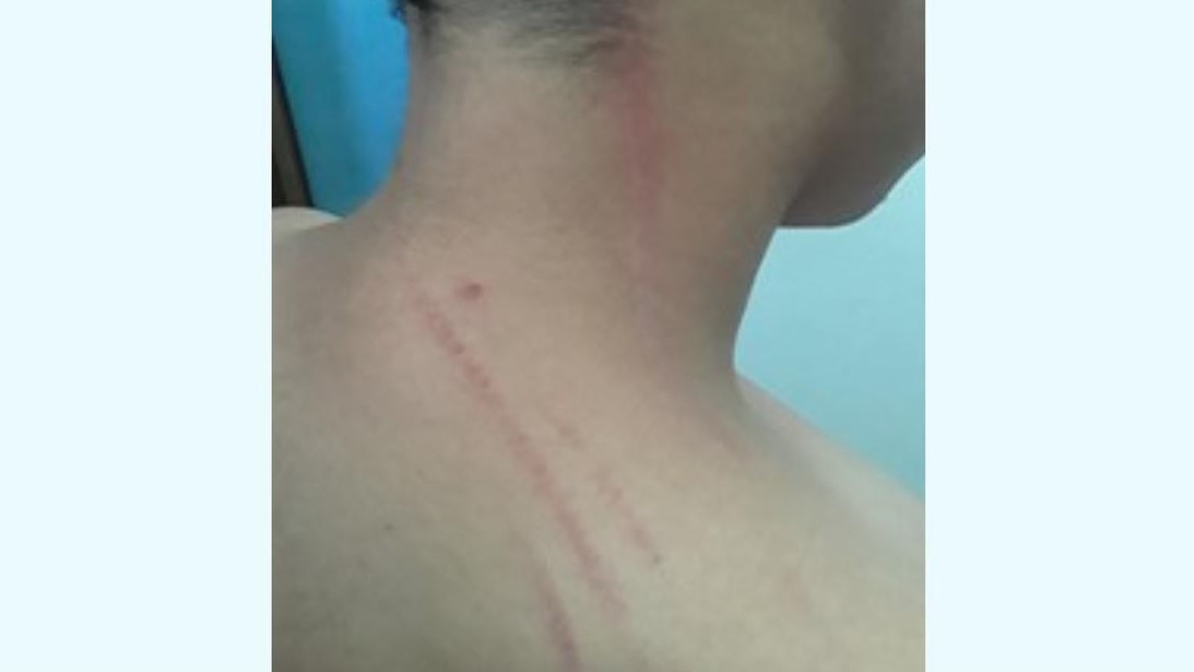 Marcas de arañazos y golpes recibidos por el niño César Raidel Corzo Sánchez.