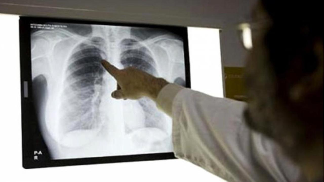 Análisis de un paciente diagnosticado con tuberculosis.  