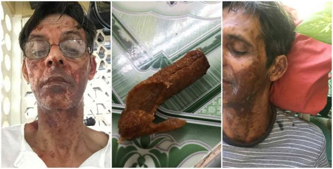 Un cubano con quemaduras tras freír 'croquetas explosivas'.