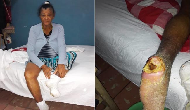 Una anciana diabética, enviada por el hospital a su casa pese a tener un pie en condiciones críticas.
