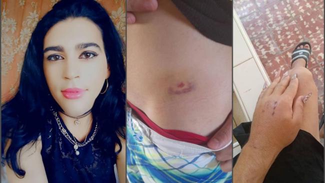 Roxana Montejo Suárez, víctima de violencia transfóbica, y dos de sus lesiones..