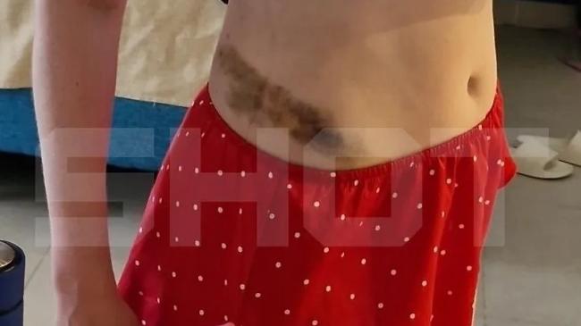 Hematoma provocado por un golpe recibido por una de las víctimas.