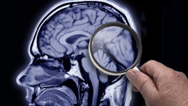 Resonancia magnética que muestra el área del cerebro de un paciente con Alzheimer.