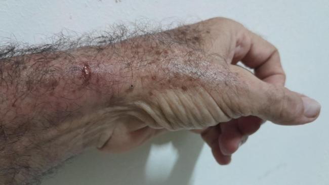Corte en la piel de la muñeca de Fernández Era provocado por las esposas.