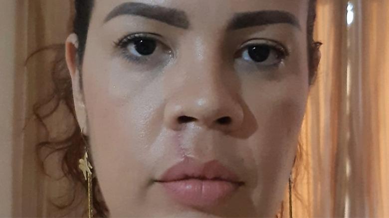 Katia Naranjo un mes de la agresión que sufrió en un concierto.